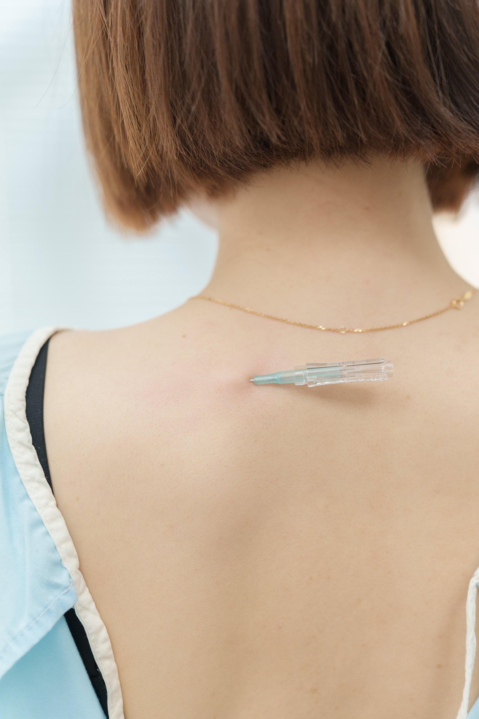 Floating Needle (FSN) therapy in progress at White Rock